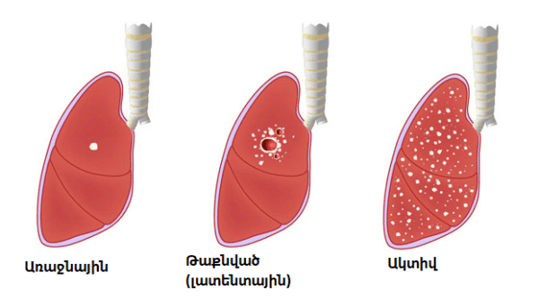 տուբերկուլյոզ