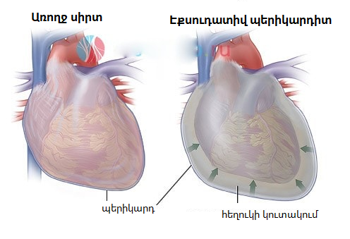 Պերիկարդիտ