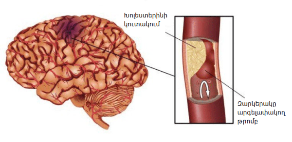 Ուղեղային իշեմիա