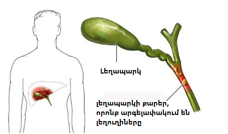 խոլեցիստիտ լեղապարկի բորբոքում