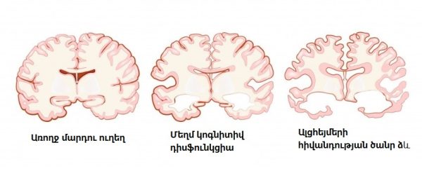 Առողջ մարդու և ալցհայմերով հիվանդի ուղեղի տարբերությունը